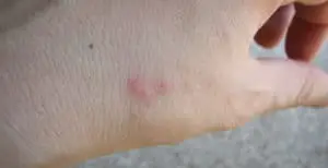 Bed Bug bites can be small or cause a rash